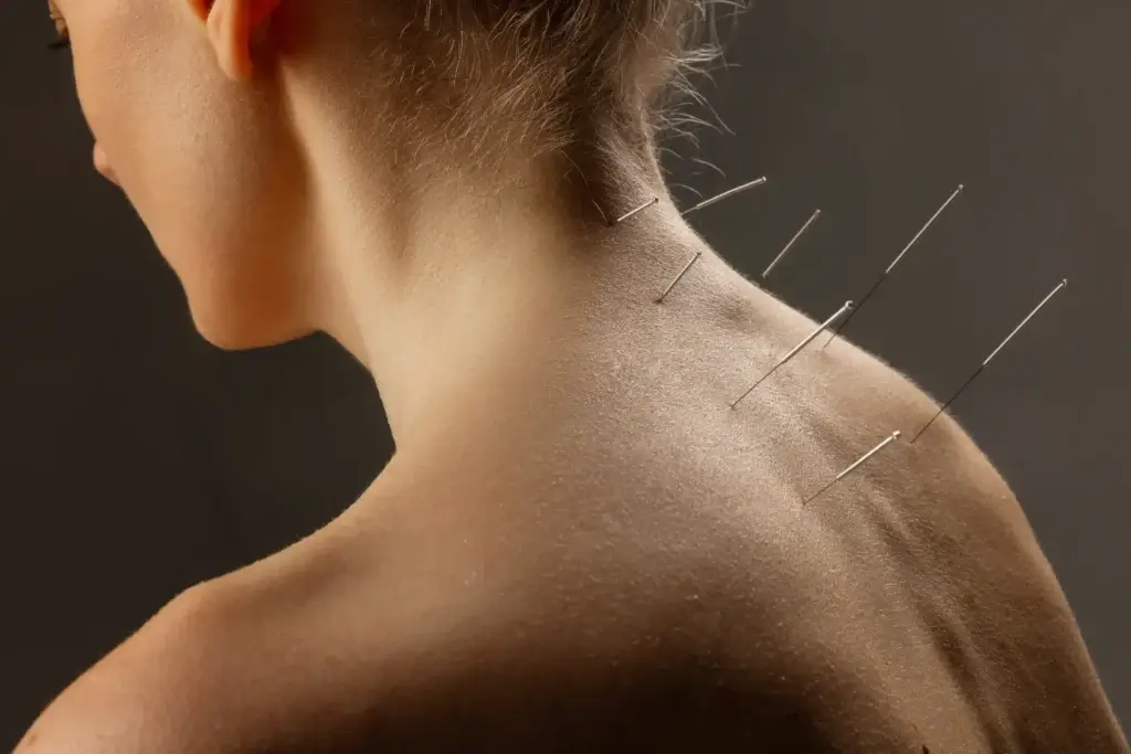 The Acupuncture Experience: What to Expect