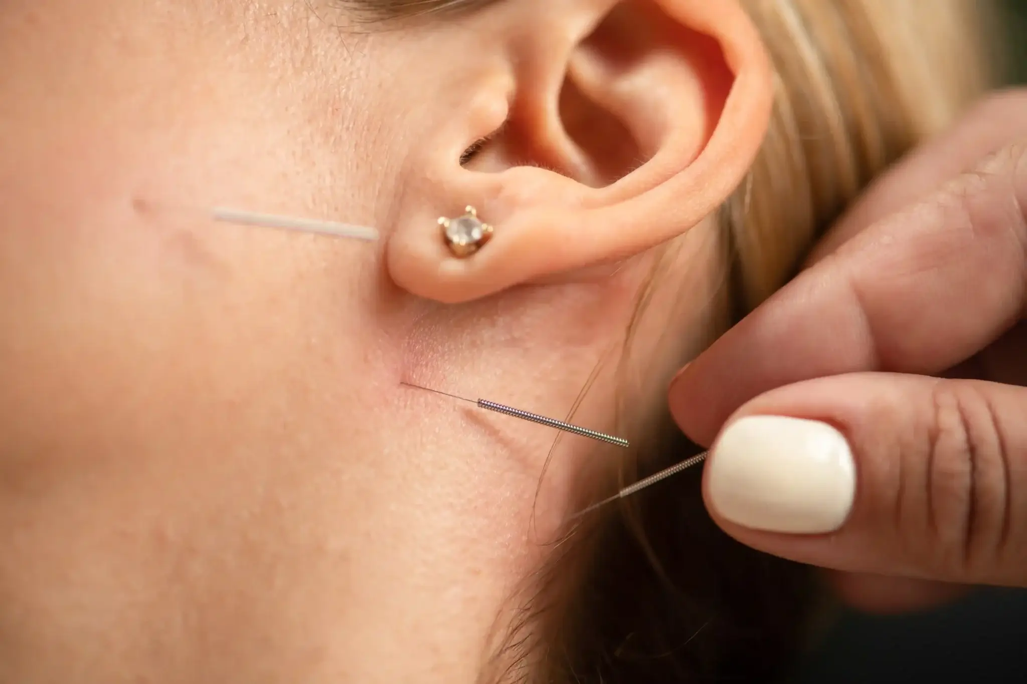 Weightloss Acupuncture Ear Seed