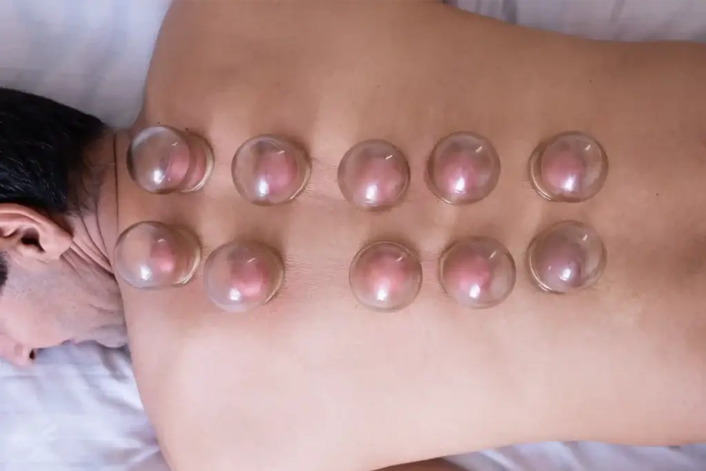 Pain & Stress Relief Cupping Massage 1 Pain & Stress Relief Cupping Massage