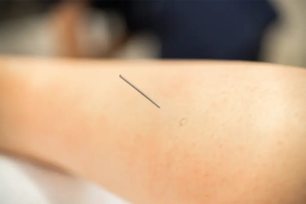 Needle Acupuncture