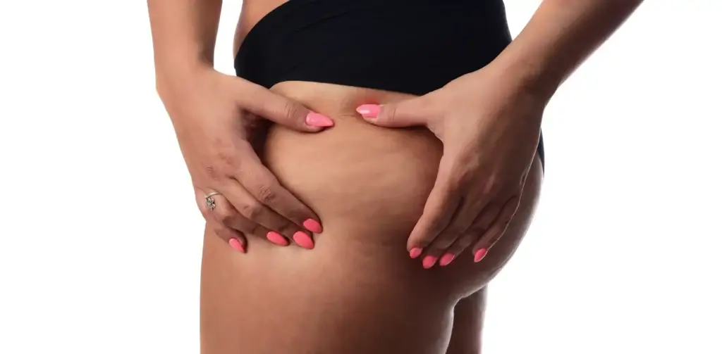 Why Choose Professional Cellulite Treatment?