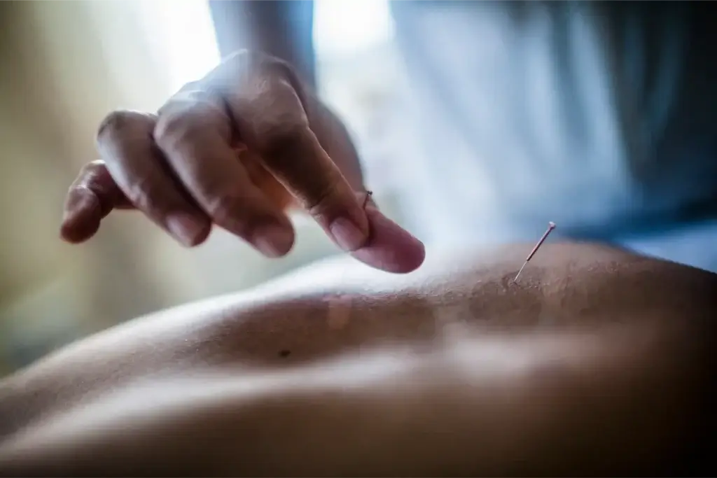 Acupuncture for Stress & Anxiety: How It Works + What to Expect 2 Patient receiving acupuncture for emotional balance and relaxation